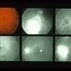Cryptococcus Cryptococcus